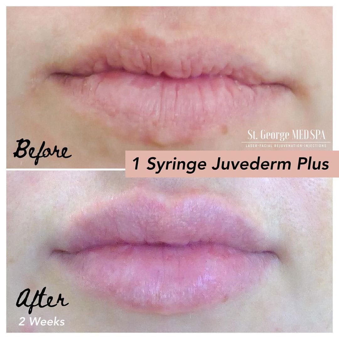 before and after photos of lip injections at st. george medspa
