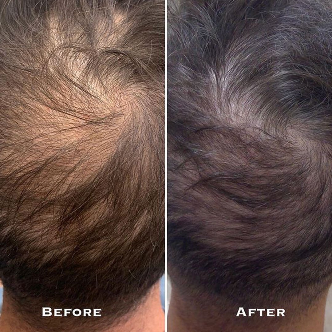 before and after 2 prp injection treatments for hair regrowth