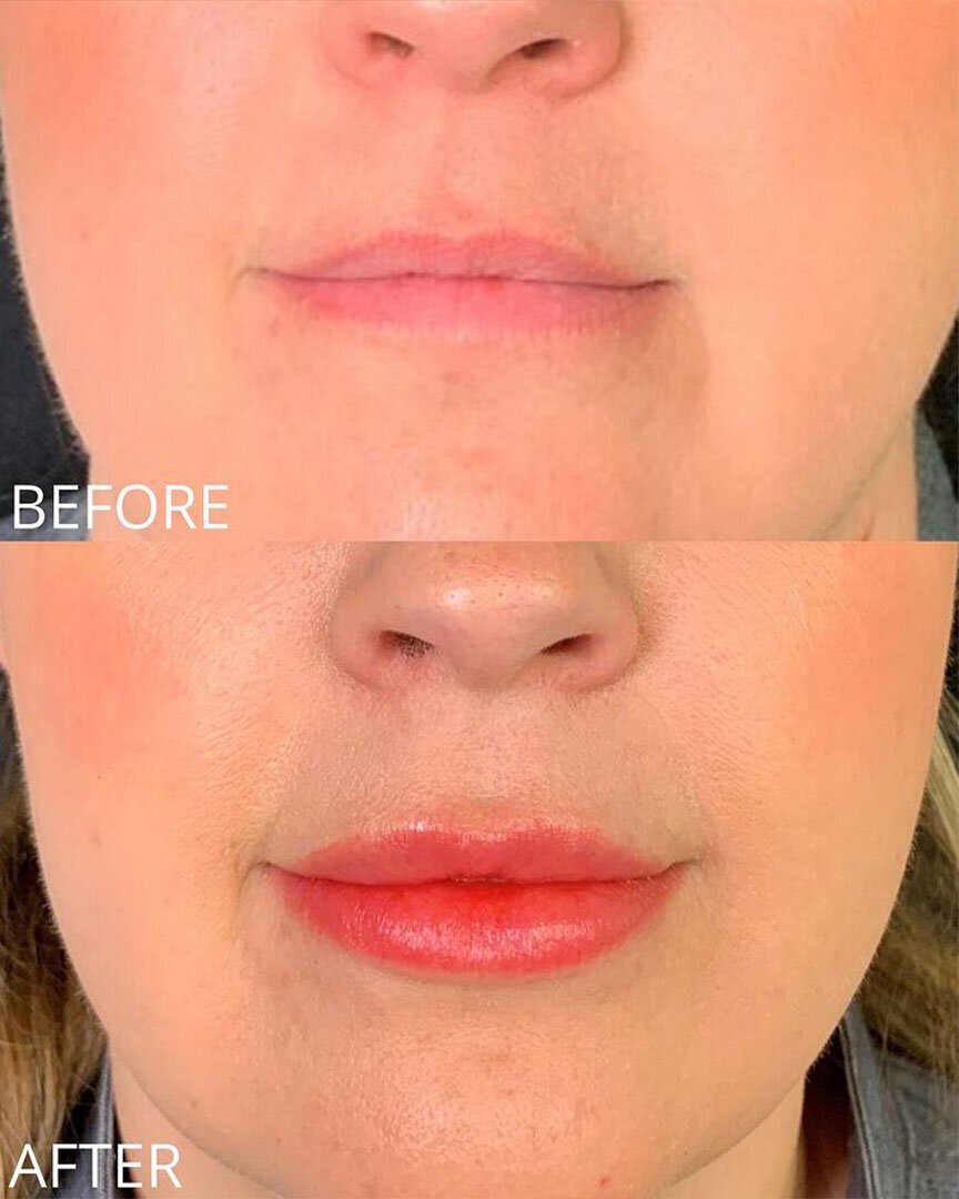 lip fillers before and after St. George Med Spa