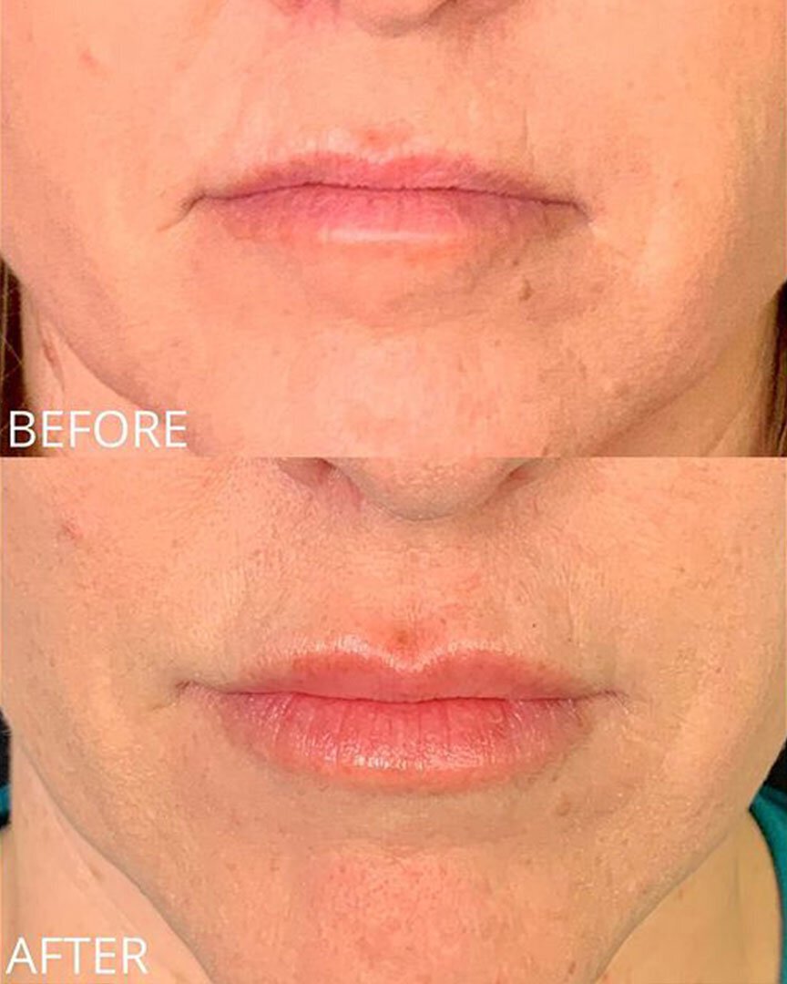 lip fillers before and after St. George Med Spa