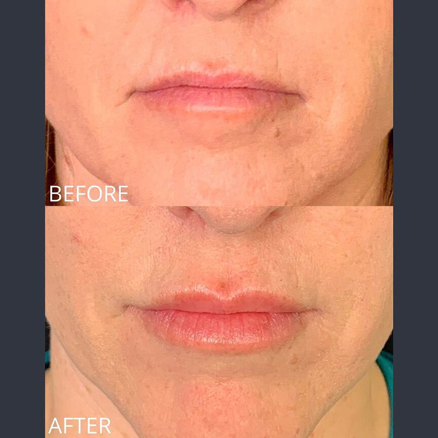 before and after dermal fillers in St. George