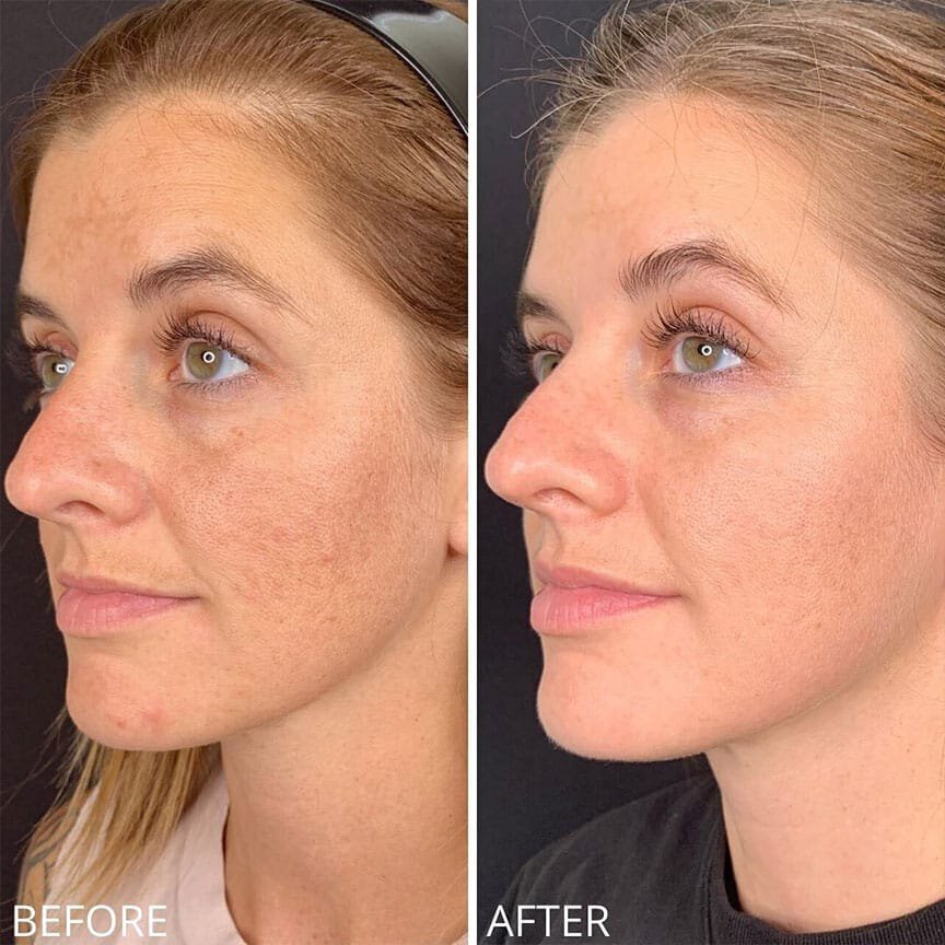 photorejuvenation laser facial before and after