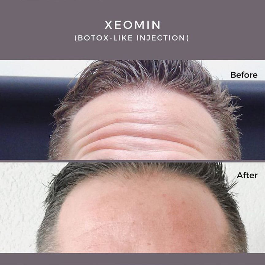 xeomin for forehead lines and wrinkles