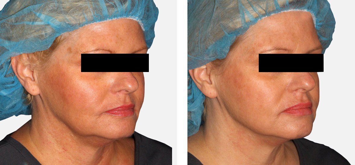 PDO Thread Lift St. UT St. Med Spa