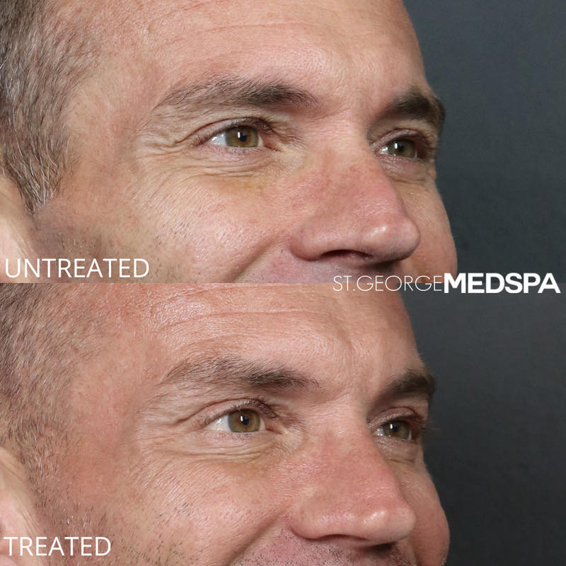Botox Before & After Image