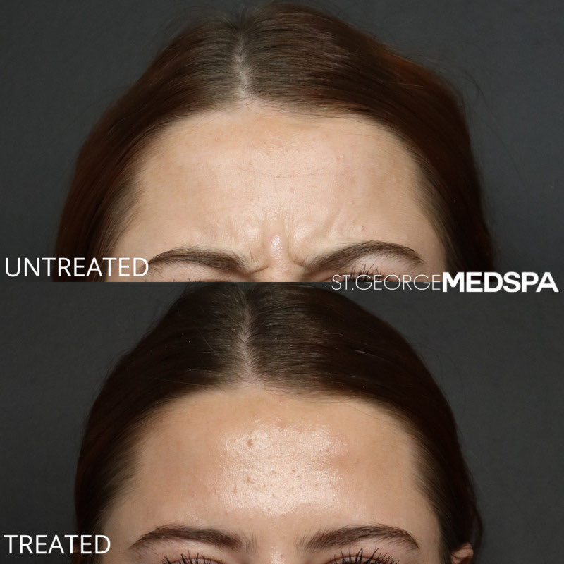 Dysport Before & After Image
