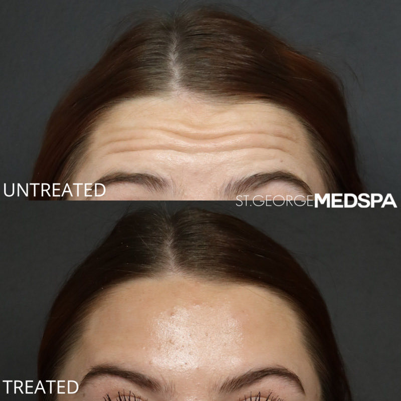 Dysport Before & After Image