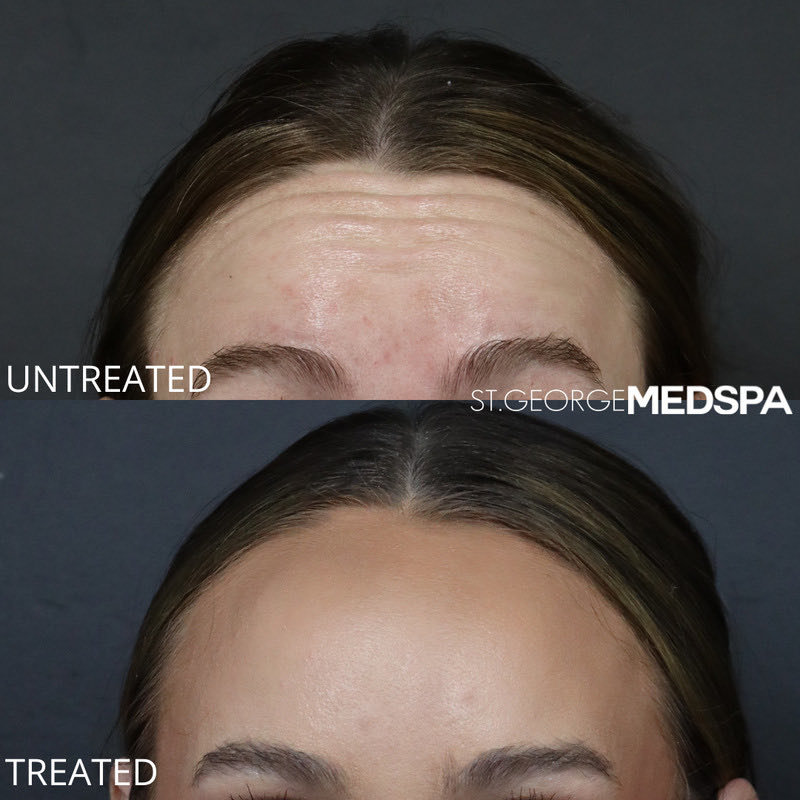 Dysport Before & After Image