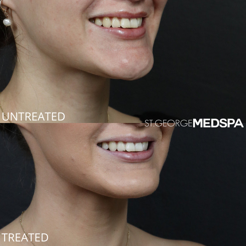 Dysport Before & After Image
