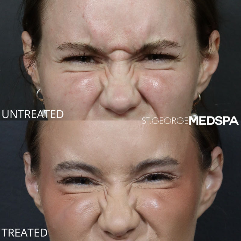 Dysport Before & After Image