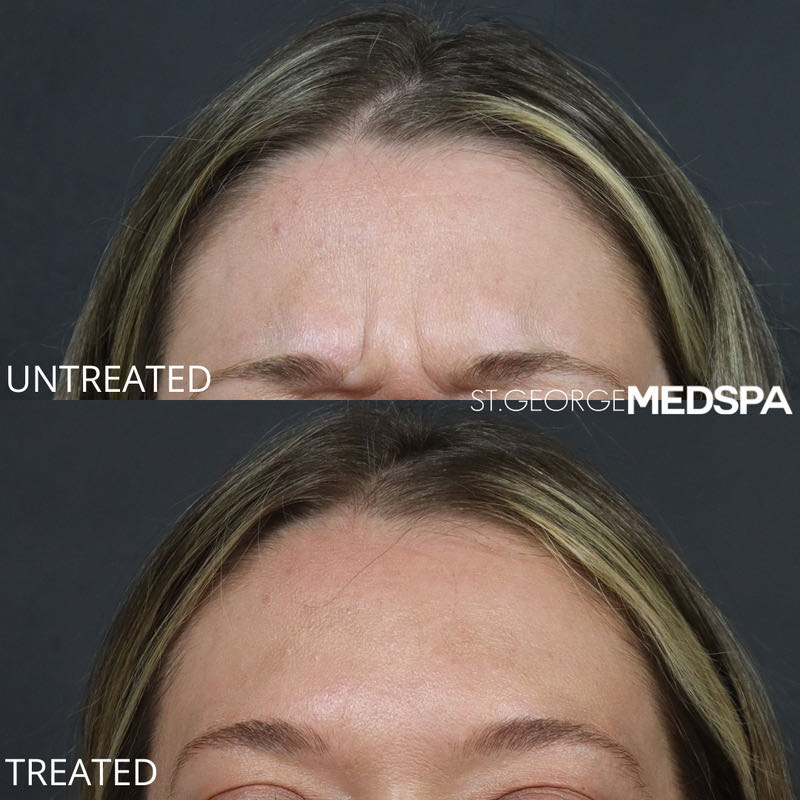 Dysport Before & After Image
