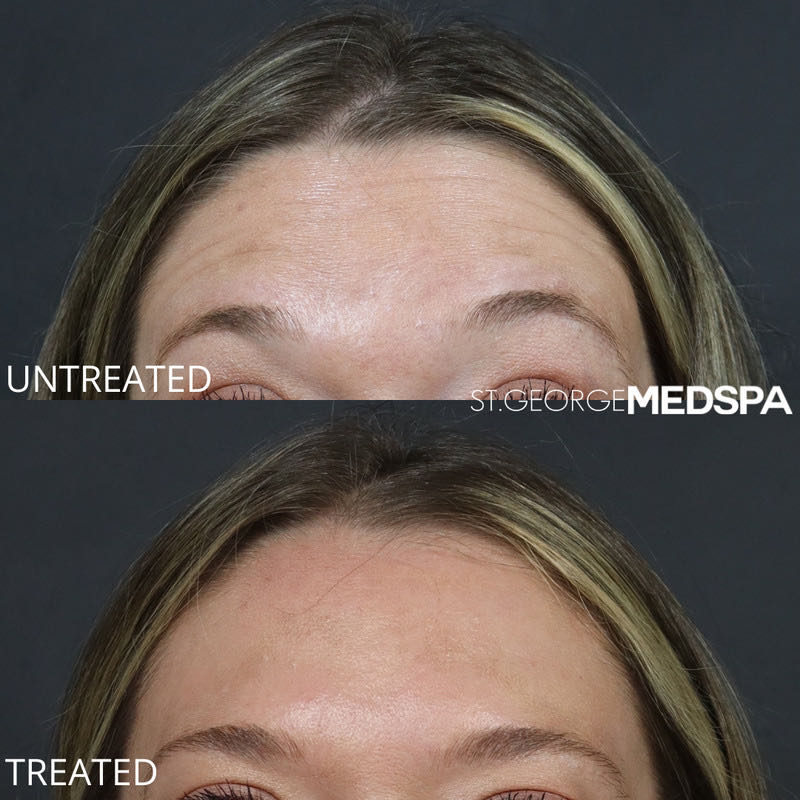 Dysport Before & After Image