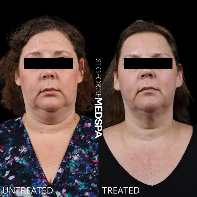 Fat Dissolving Before & After Image