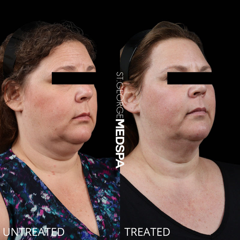 Fat Dissolving Before & After Image