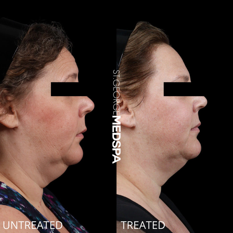 Fat Dissolving Before & After Image