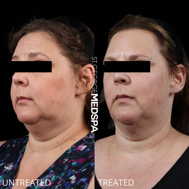 Fat Dissolving Before & After Image