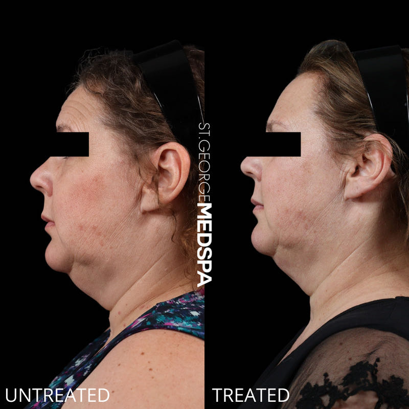 Fat Dissolving Before & After Image