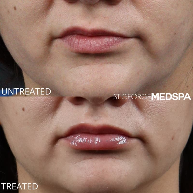 Injectables & Fillers Before & After Image