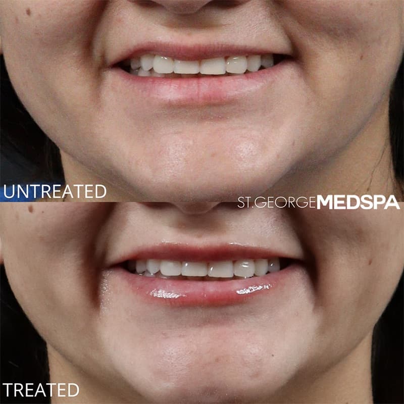 Injectables & Fillers Before & After Image