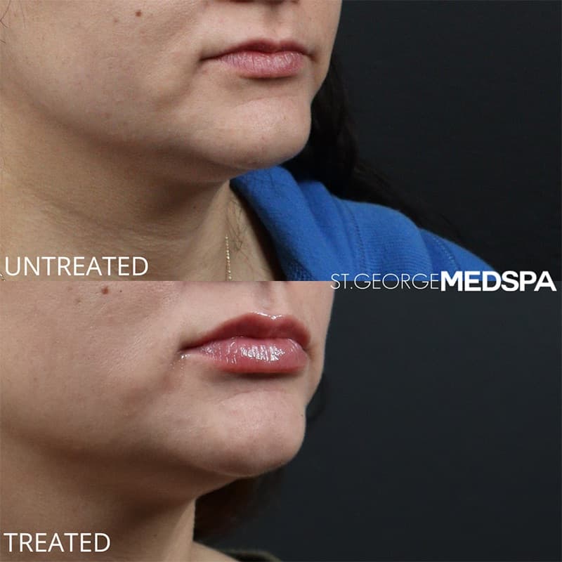 Injectables & Fillers Before & After Image