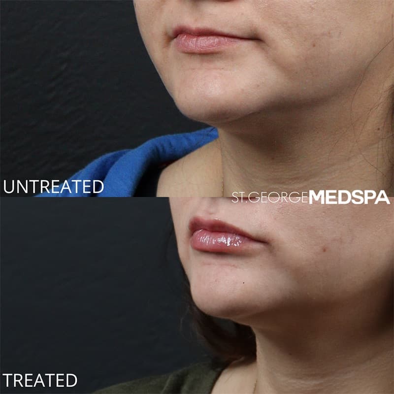 Injectables & Fillers Before & After Image