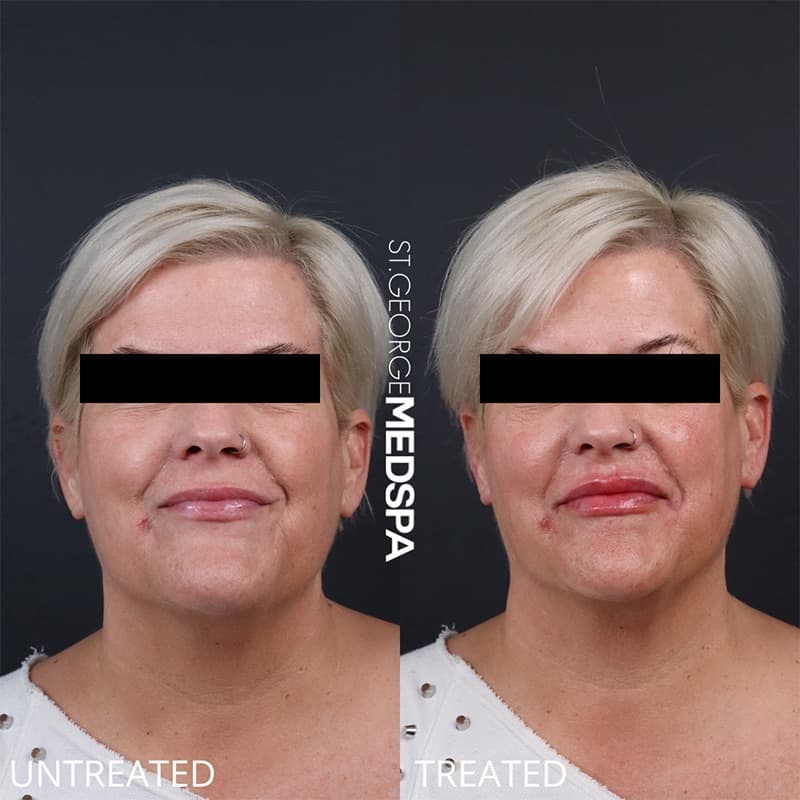 Injectables & Fillers Before & After Image