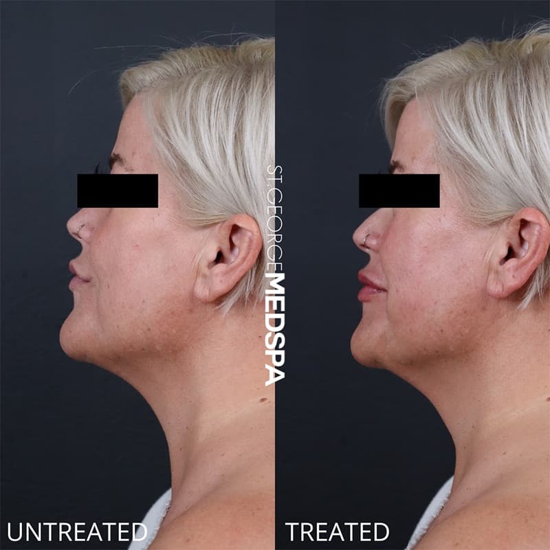 Injectables & Fillers Before & After Image