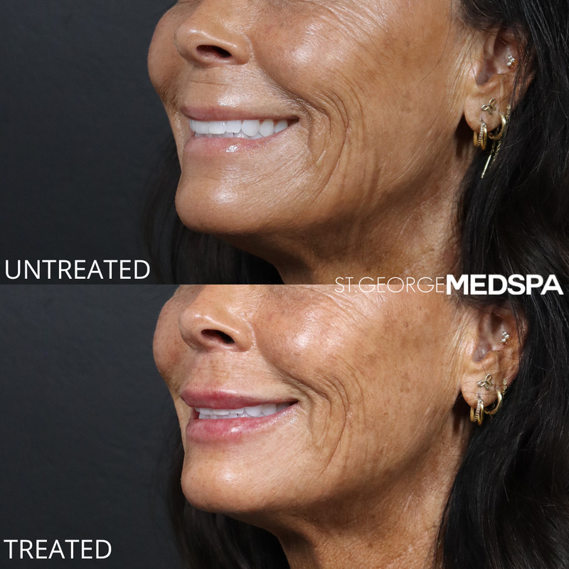 Lip Filler Before & After Image