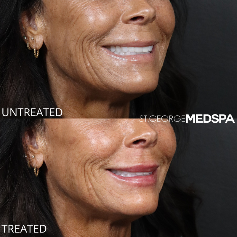 Lip Filler Before & After Image