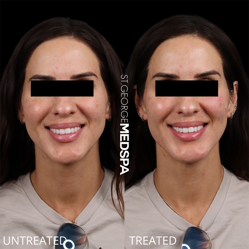 Injectables & Fillers Before & After Image