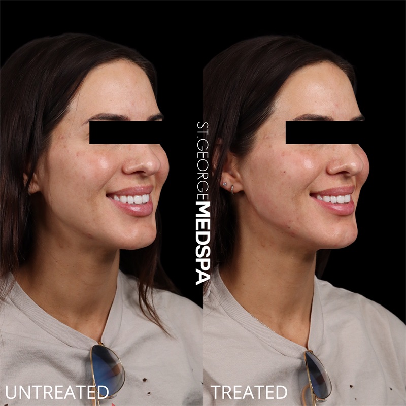 Injectables & Fillers Before & After Image