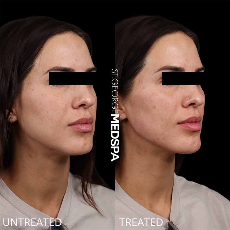 Injectables & Fillers Before & After Image