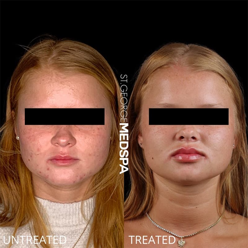 Injectables & Fillers Before & After Image