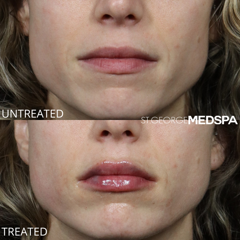 Lip Filler Before & After Image