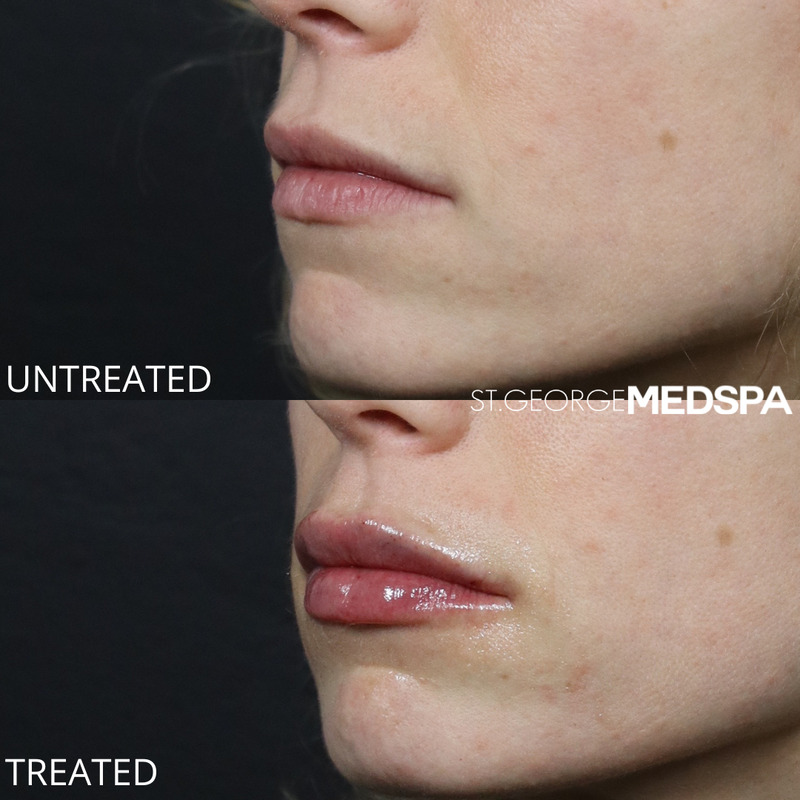 Lip Filler Before & After Image