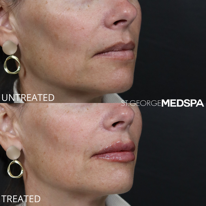 Lip Filler Before & After Image