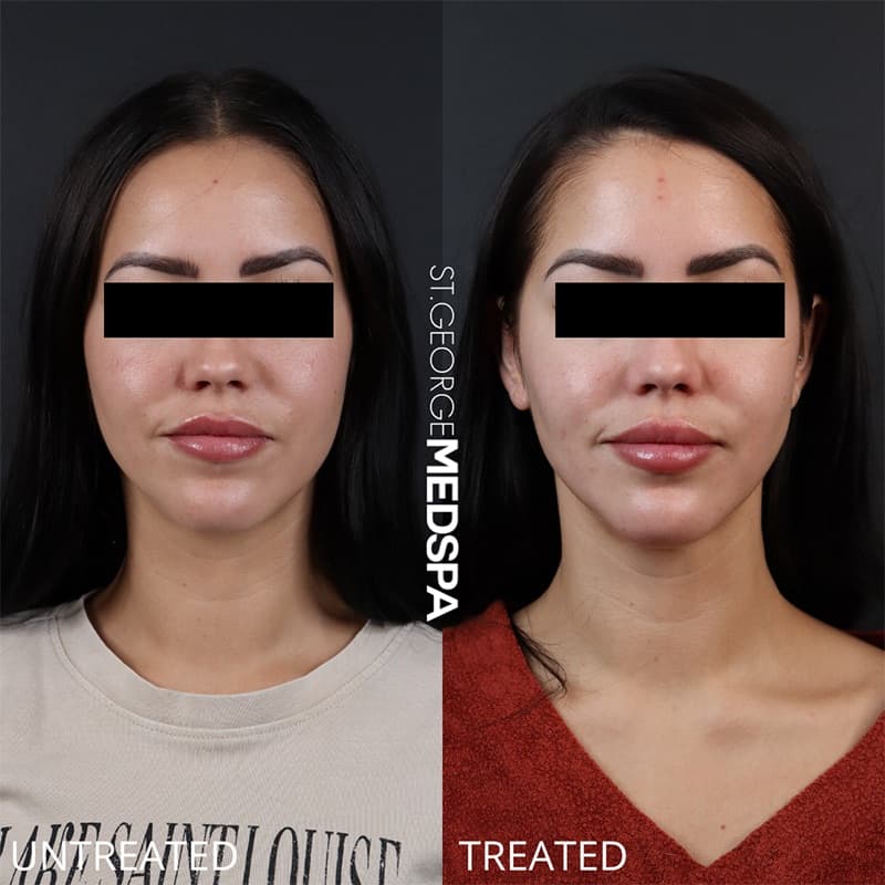 Injectables & Fillers Before & After Image