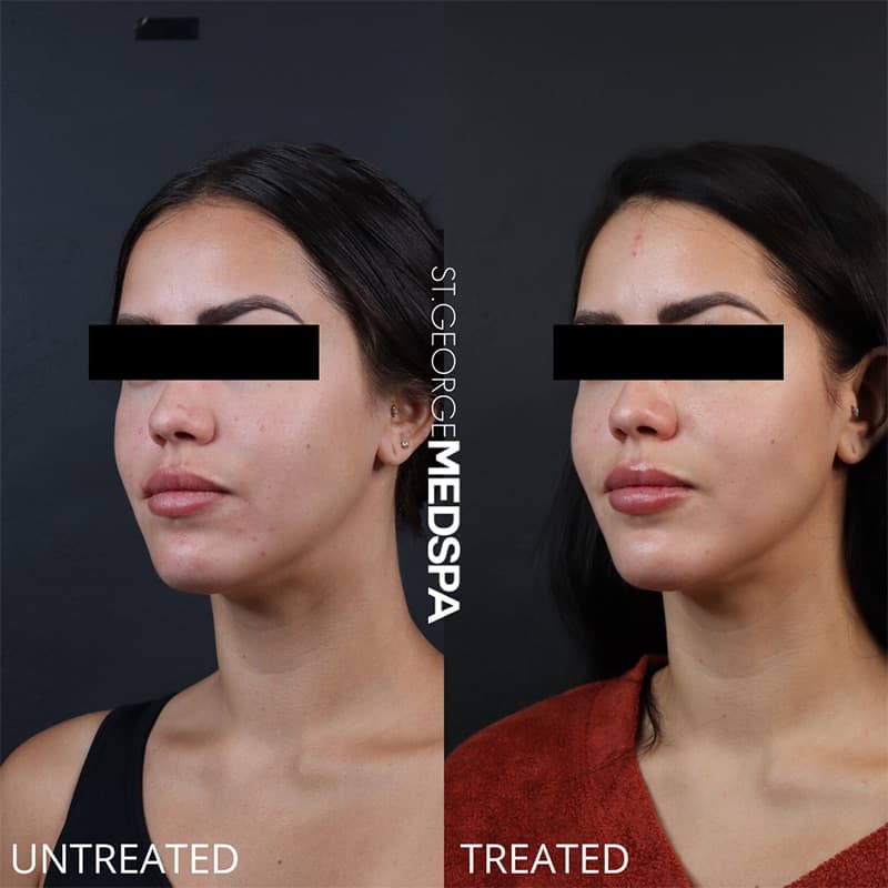 Injectables & Fillers Before & After Image