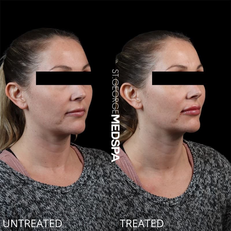 Injectables & Fillers Before & After Image