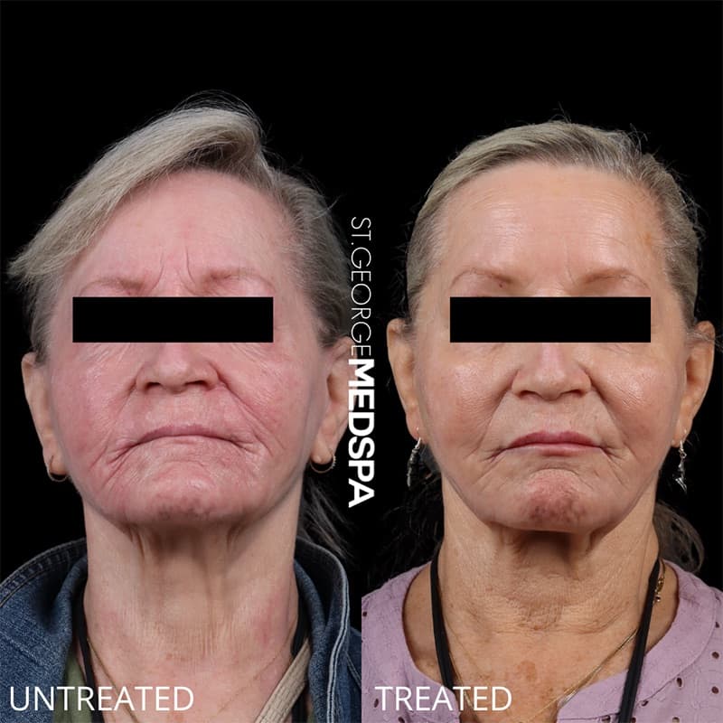 Injectables & Fillers Before & After Image