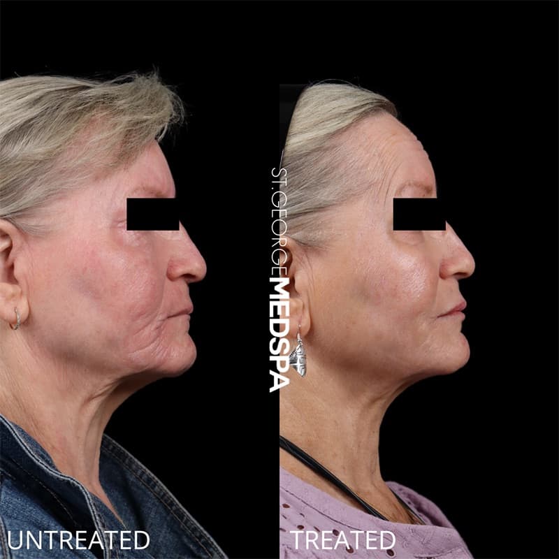 Injectables & Fillers Before & After Image