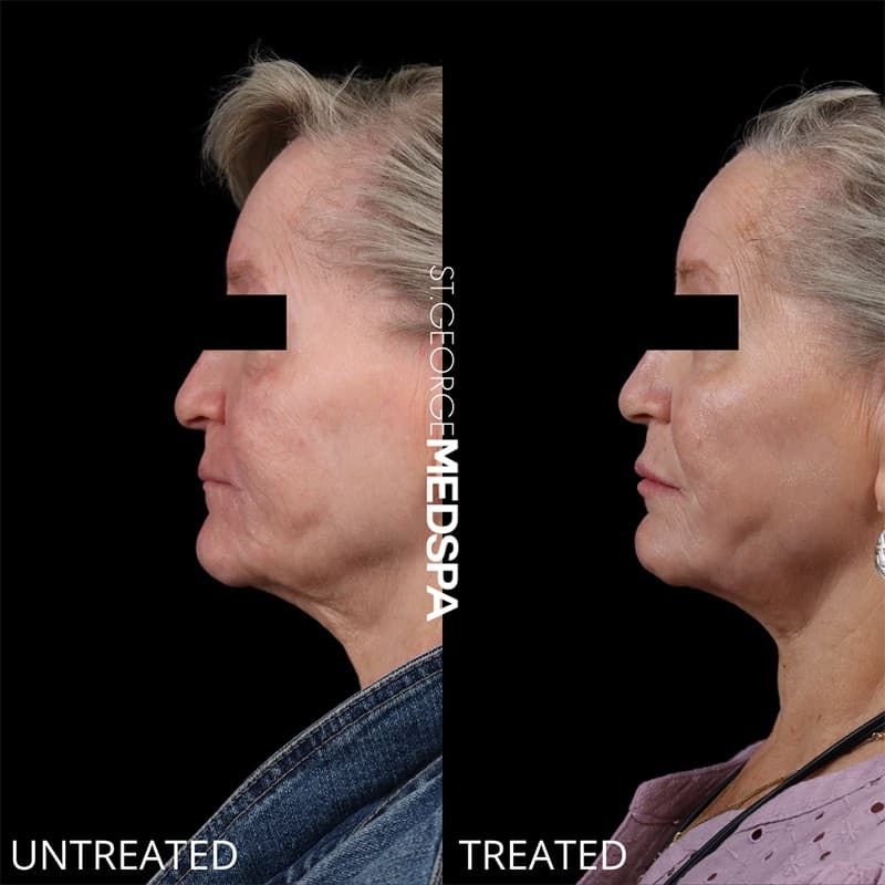 Injectables & Fillers Before & After Image