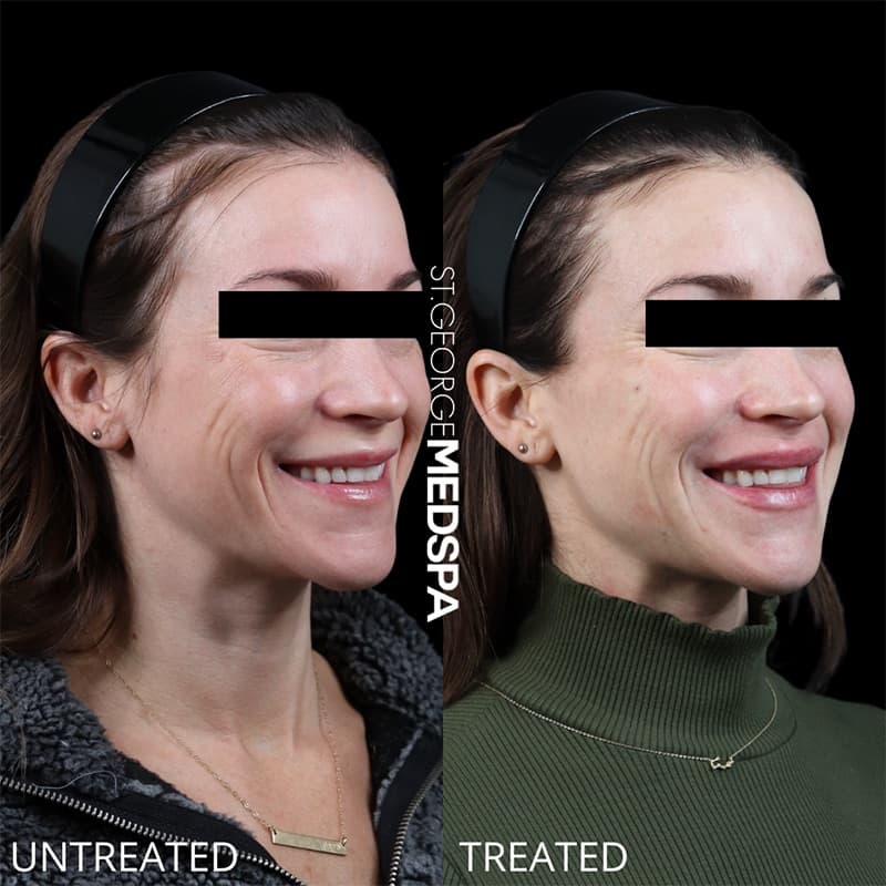 Injectables & Fillers Before & After Image