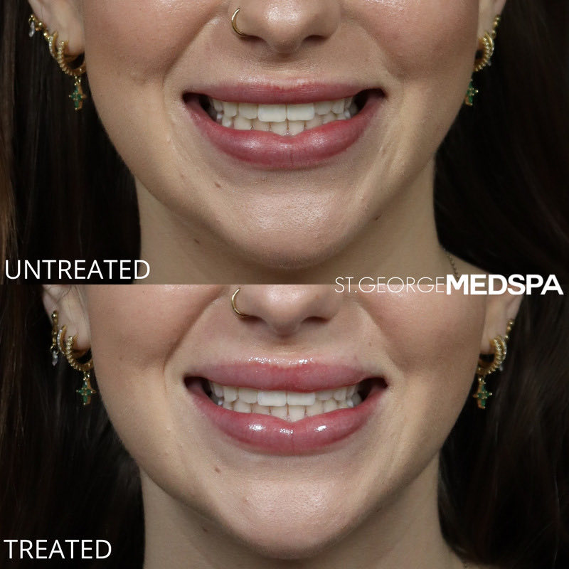 Lip Flip Before & After Image