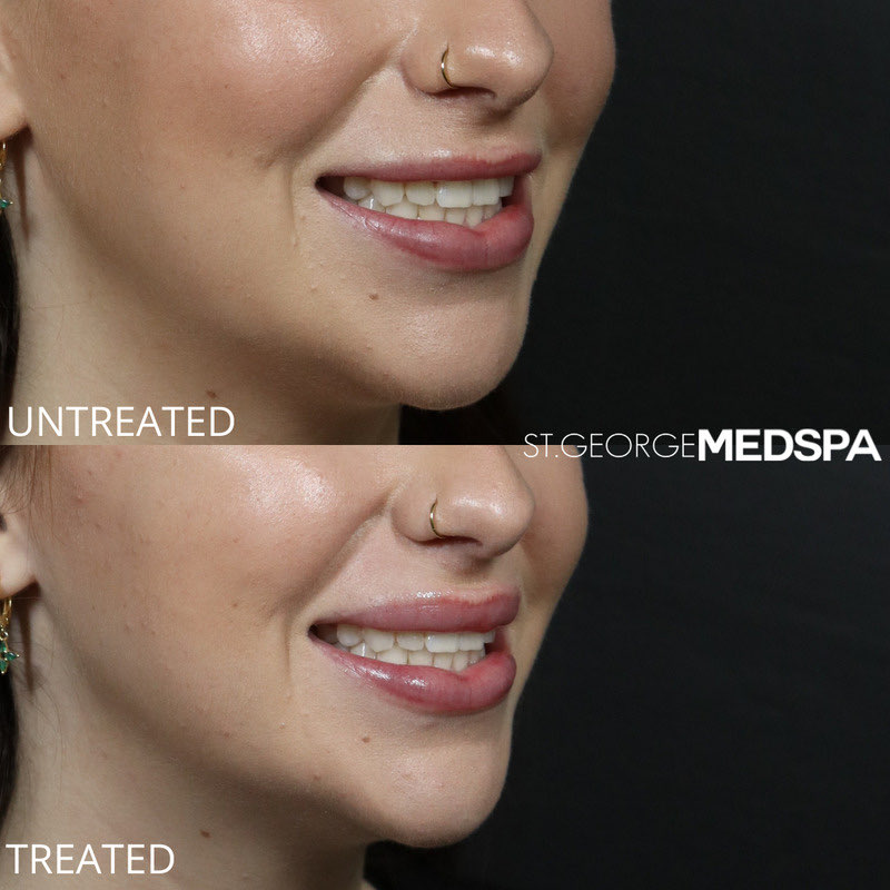 Lip Flip Before & After Image