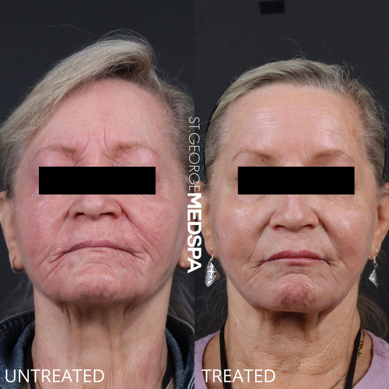 Sculptra Before & After Image