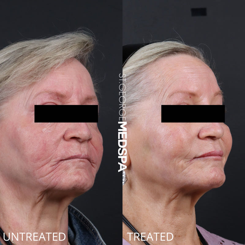 Sculptra Before & After Image