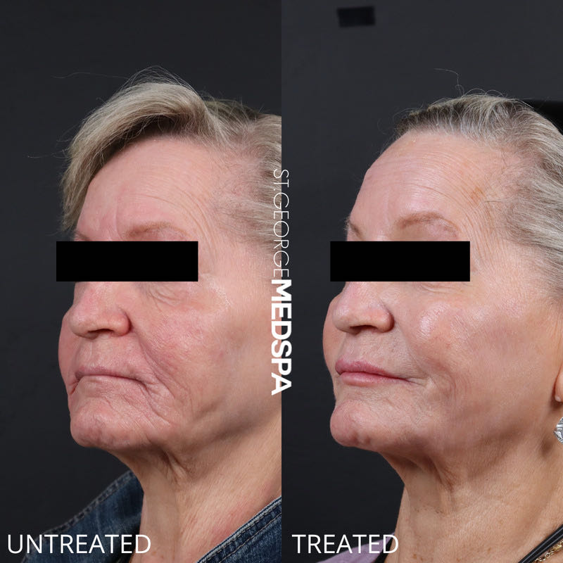 Sculptra Before & After Image