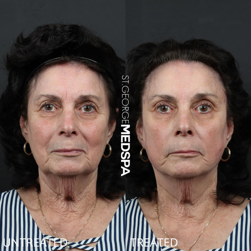 Skin Tightening Thread Before & After Image