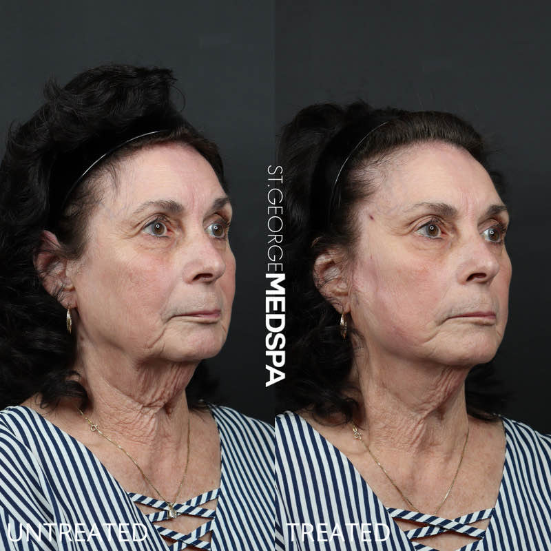 Skin Tightening Thread Before & After Image